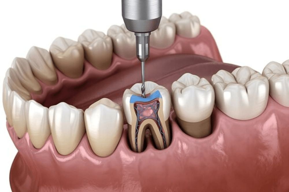 Traitement endodontique